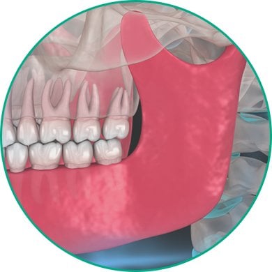illustration of Jaw Surgery